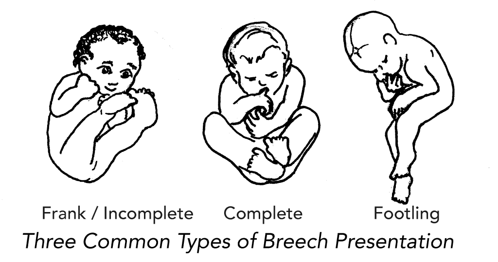 breech positions 