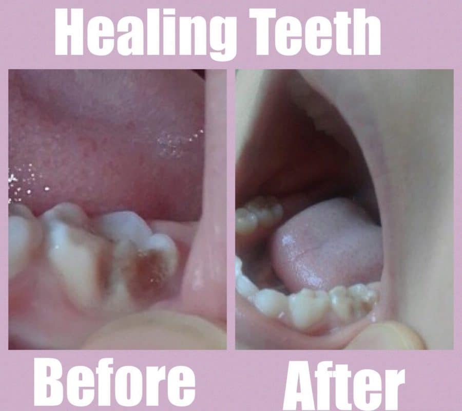 healing tooth naturally